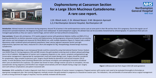 Preview of Oophorectomy at Caesarean Section for Large Mucinous Cystadenoma: A rare case report.
