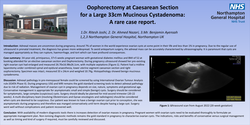 Thumbnail for Oophorectomy at Caesarean Section for Large Mucinous Cystadenoma: A rare case report.