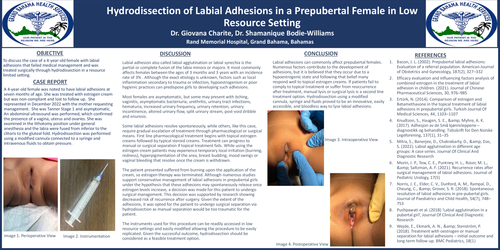 Preview of Hydrodissection of Labial Adhesions in a Prepubertal Female in Low Resource Setting