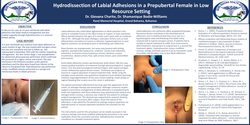 Thumbnail for Hydrodissection of Labial Adhesions in a Prepubertal Female in Low Resource Setting