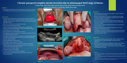 Thumbnail for Chronic puerperal complete uterine inversion due to mismanaged third stage of labour.