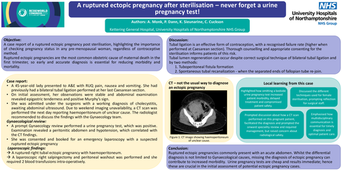 Preview of A ruptured ectopic pregnancy after sterilisation – never forget a urine pregnancy test!