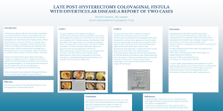 Thumbnail for Late Post-Hysterectomy Colovaginal fistula with Diverticular disease : A report of 2 cases