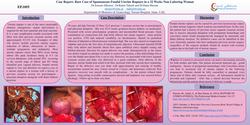 Thumbnail for Spontaneous fundal uterine rupture in a 32 weeks non-laboring woman