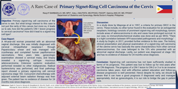 Thumbnail for A Rare Case of A Primary Signet-Ring Cell Carcinoma of the Cervix