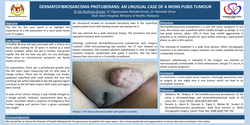 Thumbnail for DERMATOFIBROSARCOMA PROTUBERANS: An unusual case of a mons pubis tumour