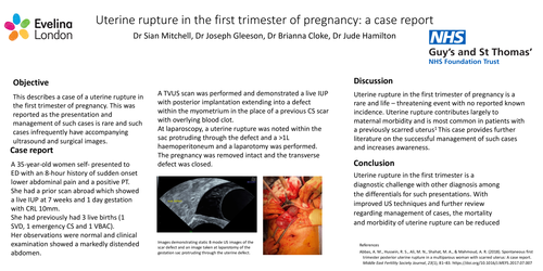 Preview of Uterine rupture in a first trimester pregnancy.