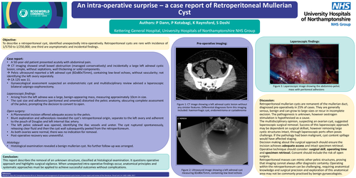 Preview of An intraoperative surprise – a case report of a Retroperitoneal Mullerian Cyst