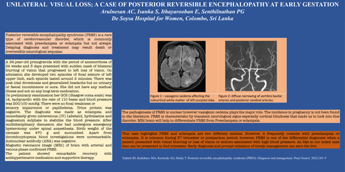 Preview of Unilateral visual loss. A case of posterior reversible encephalopathy at early gestation.