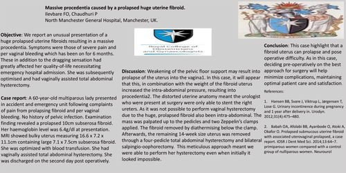 Preview of Massive procedentia caused by a prolapsed huge uterine fibroid