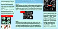 Thumbnail for Inferior Vermian Hypoplasia - A case report