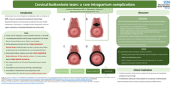 Thumbnail for Cervical buttonhole tears: a rare intrapartum complication