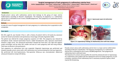 Preview of Surgical management of twin pregnancy in rudimentary uterine horn