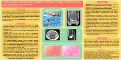 Thumbnail for Uterine leiomyomatosis: Preserving fertility in a young 23-year-old woman.