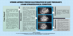 Thumbnail for Uterine Arterio-Venous Malformation with early pregnancy, A rare gynecological condition.