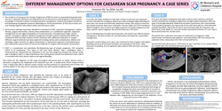 Thumbnail for DIFFERENT MANAGEMENT OPTIONS WITH CAESAREAN SCAR ECTOPIC PREGNANCY