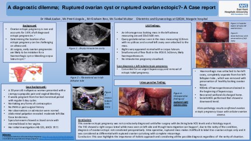 Preview of A diagnostic dilemma; Ruptured left hemorrhagic cyst or ruptured ovarian ectopic?