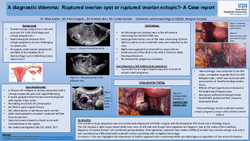 Thumbnail for A diagnostic dilemma; Ruptured left hemorrhagic cyst or ruptured ovarian ectopic?