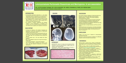 Thumbnail for Leiomyomatosis peritonealis disseminata (LPD)and meningioma- a rare association