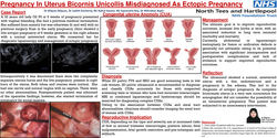 Thumbnail for Pregnancy in Uterus bicornis unicollis misdiagnosed as an ectopic pregnancy.