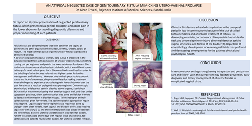 Preview of AN ATYPICAL NEGLECTED CASE OF GENITOURINARY FISTULA MIMICKING UTERO-VAGINAL PROLAPSE
