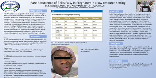 Preview of Rare Occurrence of Bell's Palsy in Pregnancy in a Low Resource Setting