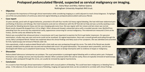 Preview of Prolapsed pedunculated fibroid, suspected as cervical malignancy on imaging.