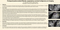 Thumbnail for Prolapsed pedunculated fibroid, suspected as cervical malignancy on imaging.