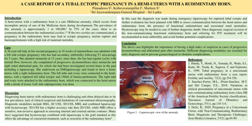 Preview of TUBAL ECTOPIC PREGNANCY IN A HEMI-UTERUS WITH A RUDIMENTARY HORN:CASE REPORT