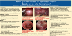 Thumbnail for Laparoscopy in Genital Tuberculosis - Does the eye see what the mind knows?