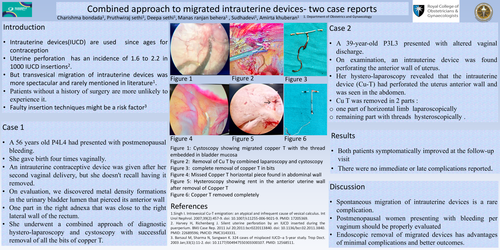 Preview of Combined approach to migrated intrauterine devices- two case reports
