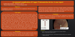 Thumbnail for An unusual complication of Copper T-intrauterine device: A case report