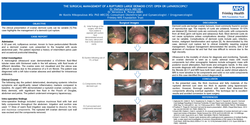 Thumbnail for The surgical management of ruptured large dermoid cyst: Open or Laparoscopic.