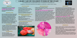Thumbnail for A RARE CASE OF COLLISION TUMOR OF THE OVARY