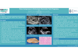 Thumbnail for Fetus Compressus in Dichorionic Diamniotic Twin Pregnancy