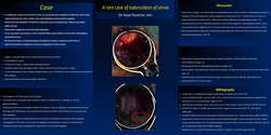 Thumbnail for Case of cervical tuberculosis presenting as growth