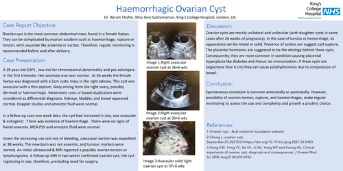 Preview of Hemorrhagic ovarian cyst