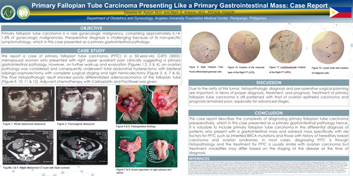 Preview of Primary Fallopian Tube Carcinoma Presenting Like a Primary Gastrointestinal Mass: Case Report