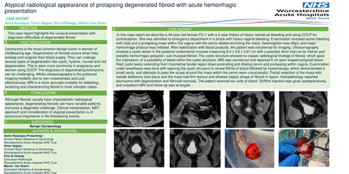 Preview of Atypical radiological appearance of prolapsing degenerated fibroid with acute haemorrhagic presentation