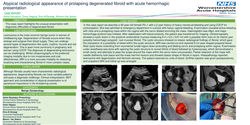 Thumbnail for Atypical radiological appearance of prolapsing degenerated fibroid with acute haemorrhagic presentation