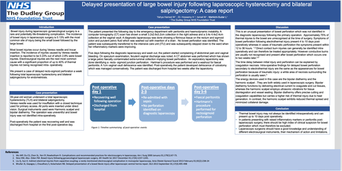 Preview of Delayed presentation of large bowel injury following laparoscopic hysterectomy and bilateral salpingectomy