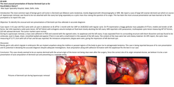 Thumbnail for The most unusual presentation of Ovarian Dermoid Cyst so far