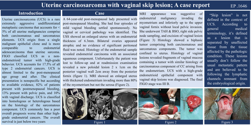 Preview of Uterine carcinosarcoma with vaginal skip lesion;A case report