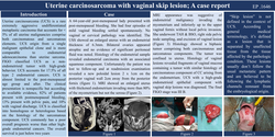 Thumbnail for Uterine carcinosarcoma with vaginal skip lesion;A case report