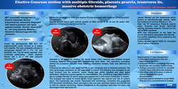 Thumbnail for Elective Caesarean Section, multiple fibroids , transverse lie, placenta previaMassive Obstetrics Hemorrhage.