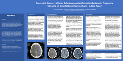 Thumbnail for Successful Recovery after Arteriovenous Malformation Excision in Pregnancy Following Occipital Lobe Haemorrhage