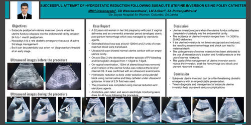 Preview of SUCCESSFUL ATTEMPT OF HYDROSTATIC REDUCTION FOLLOWING SUBACUTE UTERINE INVERSION USING FOLEY CATHETER