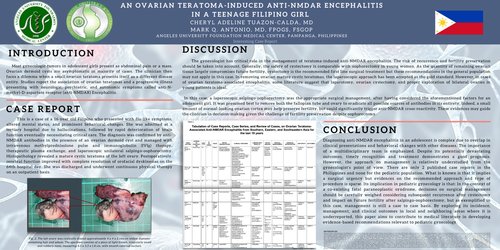 Preview of An Ovarian Teratoma-Induced Anti-NMDAR Encephalitis in a Teenage Filipino Girl
