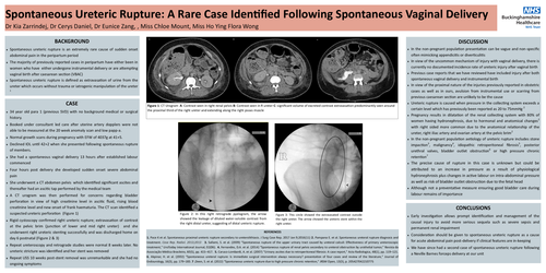 Preview of Spontaneous Ureteric Rupture: A Rare Case Identified Following Spontaneous Vaginal Delivery