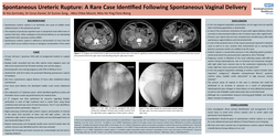 Thumbnail for Spontaneous Ureteric Rupture: A Rare Case Identified Following Spontaneous Vaginal Delivery